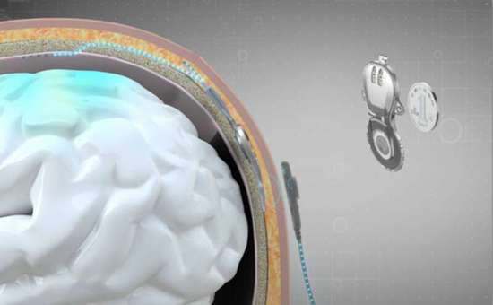 清华首例无线微创脑机接口临床试验成功！