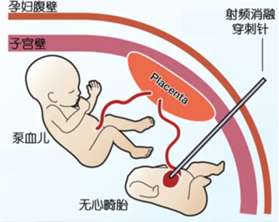 双胞胎一<em>胎</em>“无<em>心</em>”还在抽另一胎血，上海医护联手救治产妇和...