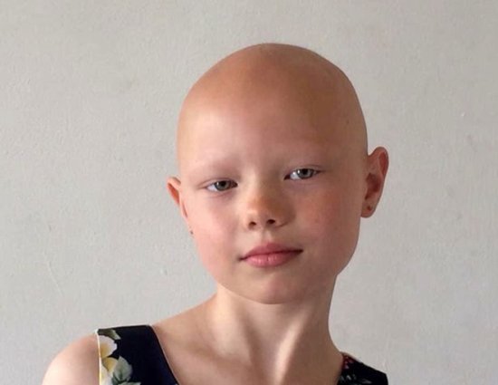英国8岁女孩患脱发症拒绝假发 签约<em>模特公司</em>展现独特外貌