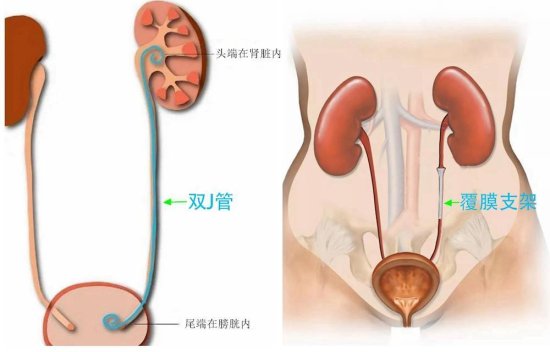 <em>常</em>德一医成功开展湘西北首例覆膜支架置入术治疗输尿管狭窄