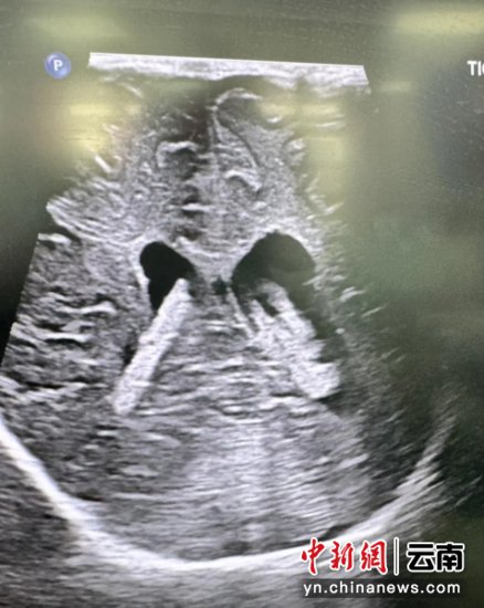 完全性肺静脉异位引流“紫宝宝”在云南省阜外医院获得救治