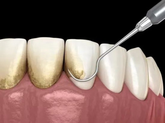 小心牙齿患上“节后综合征”