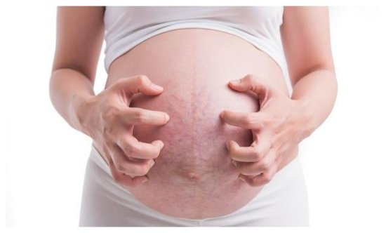 怀孕日记：生完一胎消失的<em>妊娠纹</em>，二胎就明目张胆显现在肚子上