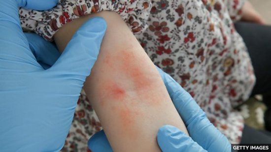 Baby sticky tape skin test can predict eczema risk 用<em>胶带做</em>皮肤...