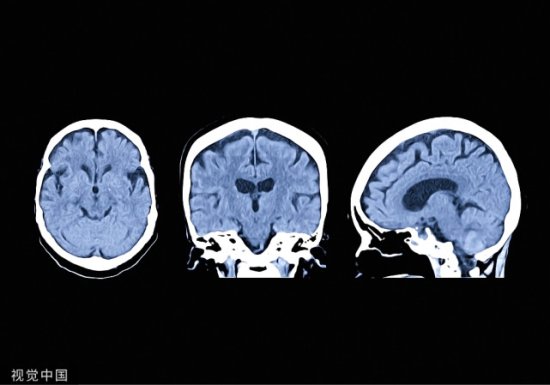 脑萎缩是痴呆<em>的前兆</em>吗？怎么分辨生理性和病理性？一文讲清