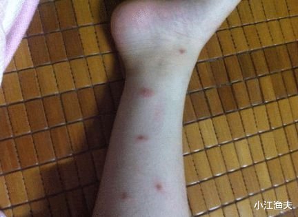孩子<em>被蚊子咬</em>了，起了大包，这是不是过敏体质呢？
